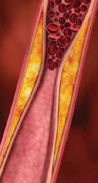 Роковой тромб: причины и симптомы закупорки сосудов