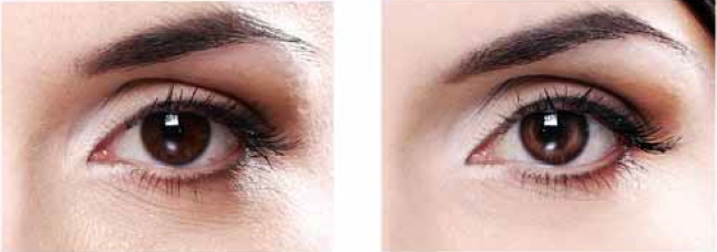 После 8 недель применения 5% Regu®-Age тёмные круги под глазами уменьшились на 35%